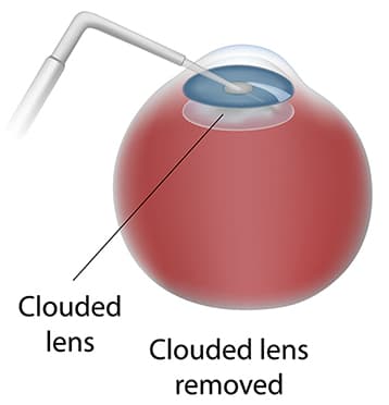 Cataract Surgery Diagram Step 1