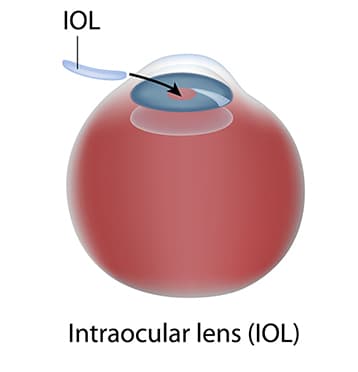 Cataract Surgery Diagram Step 2