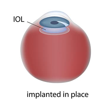 Cataract Surgery Diagram Step 3