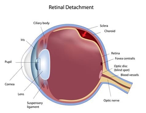 Diagram of a retinal detachment